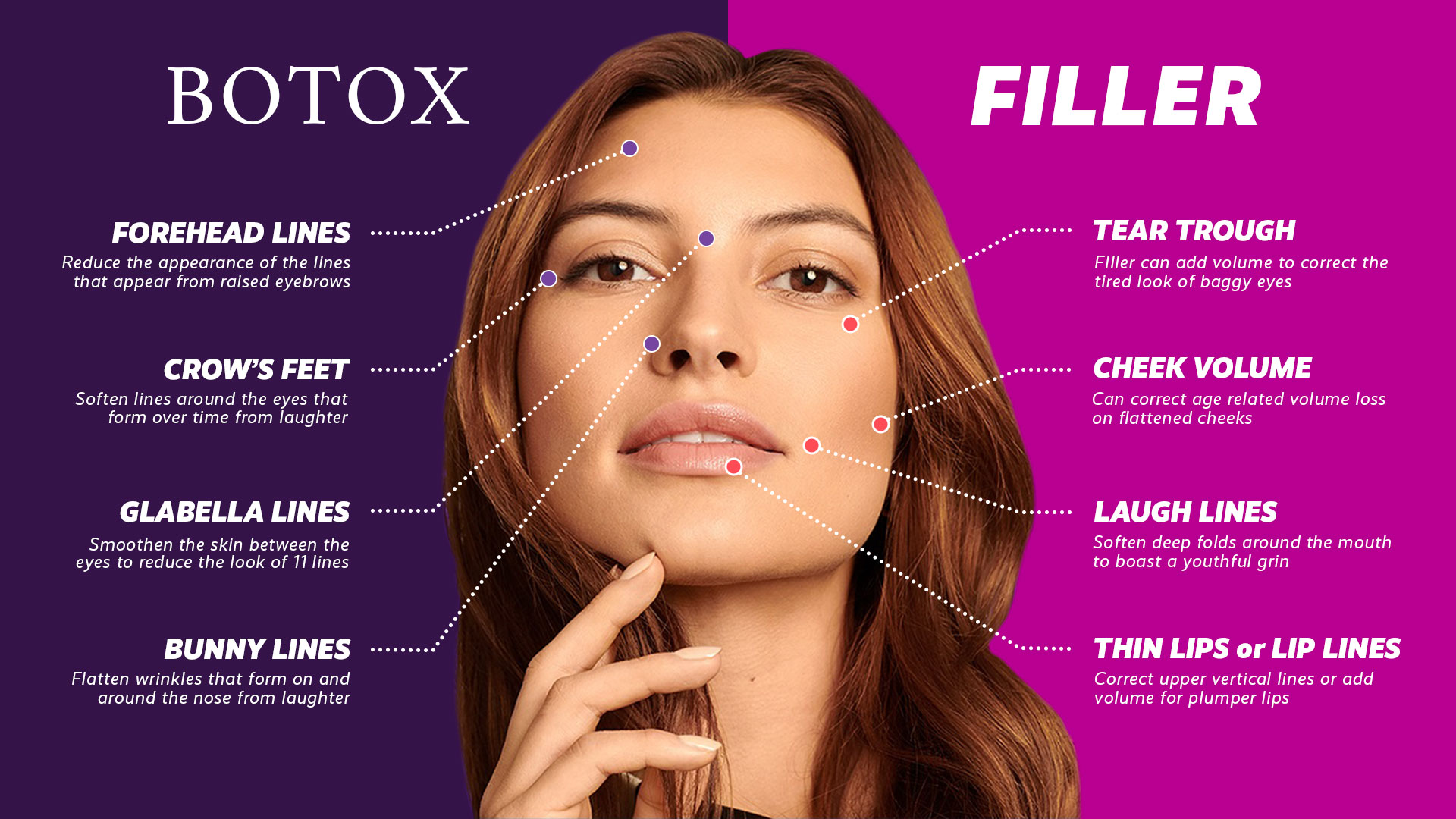 Botox for a More Youthful Appearance